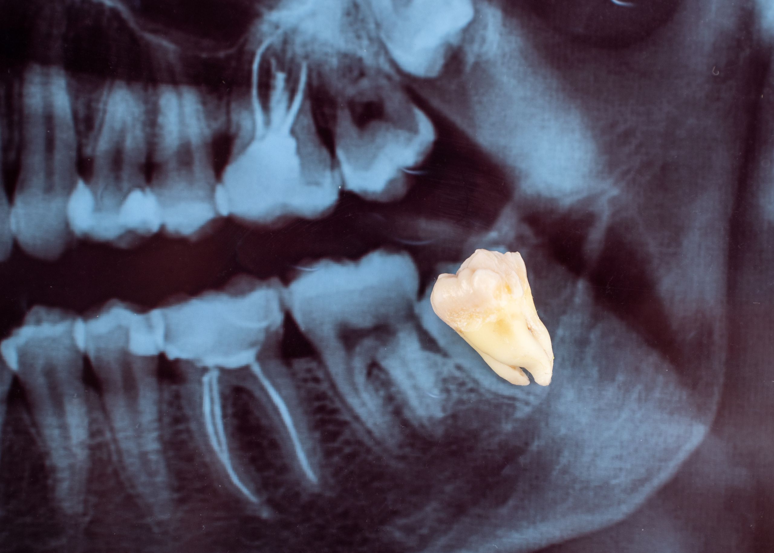 Unraveling the Mystery of Wisdom Teeth: What You Need to Know