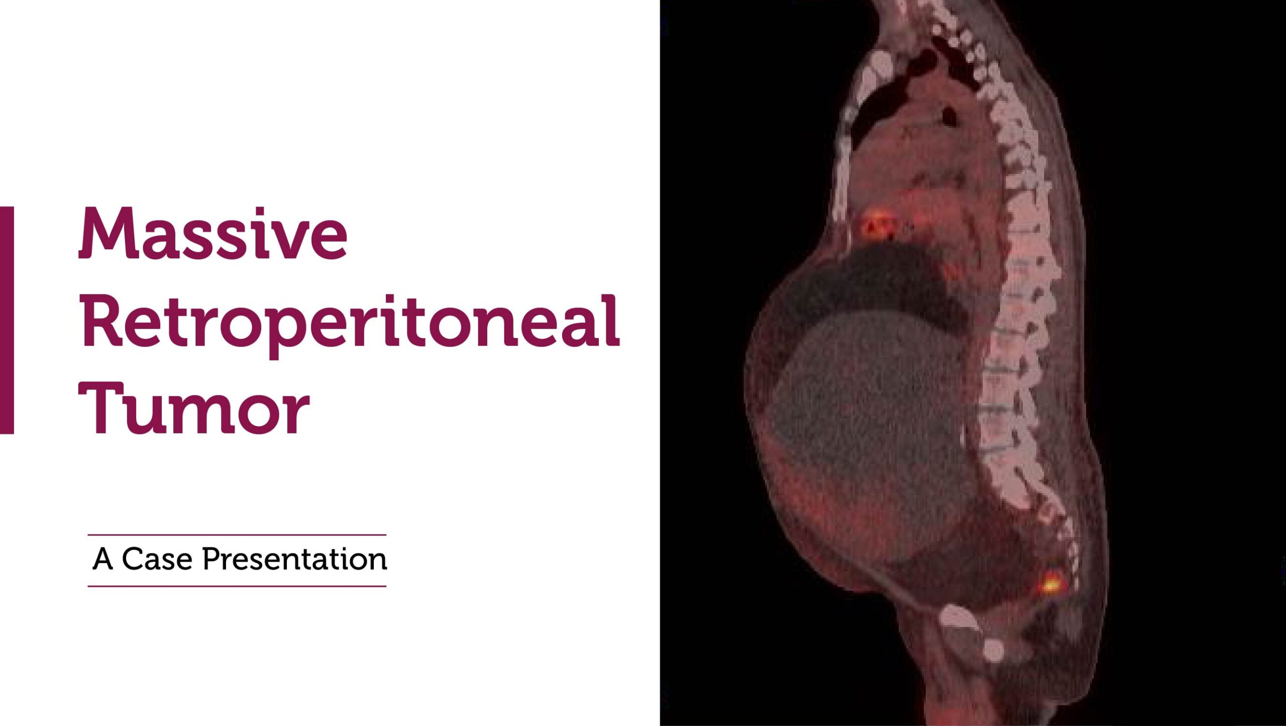A Complex Case: Surgical Management of a Massive Retroperitoneal Tumor 