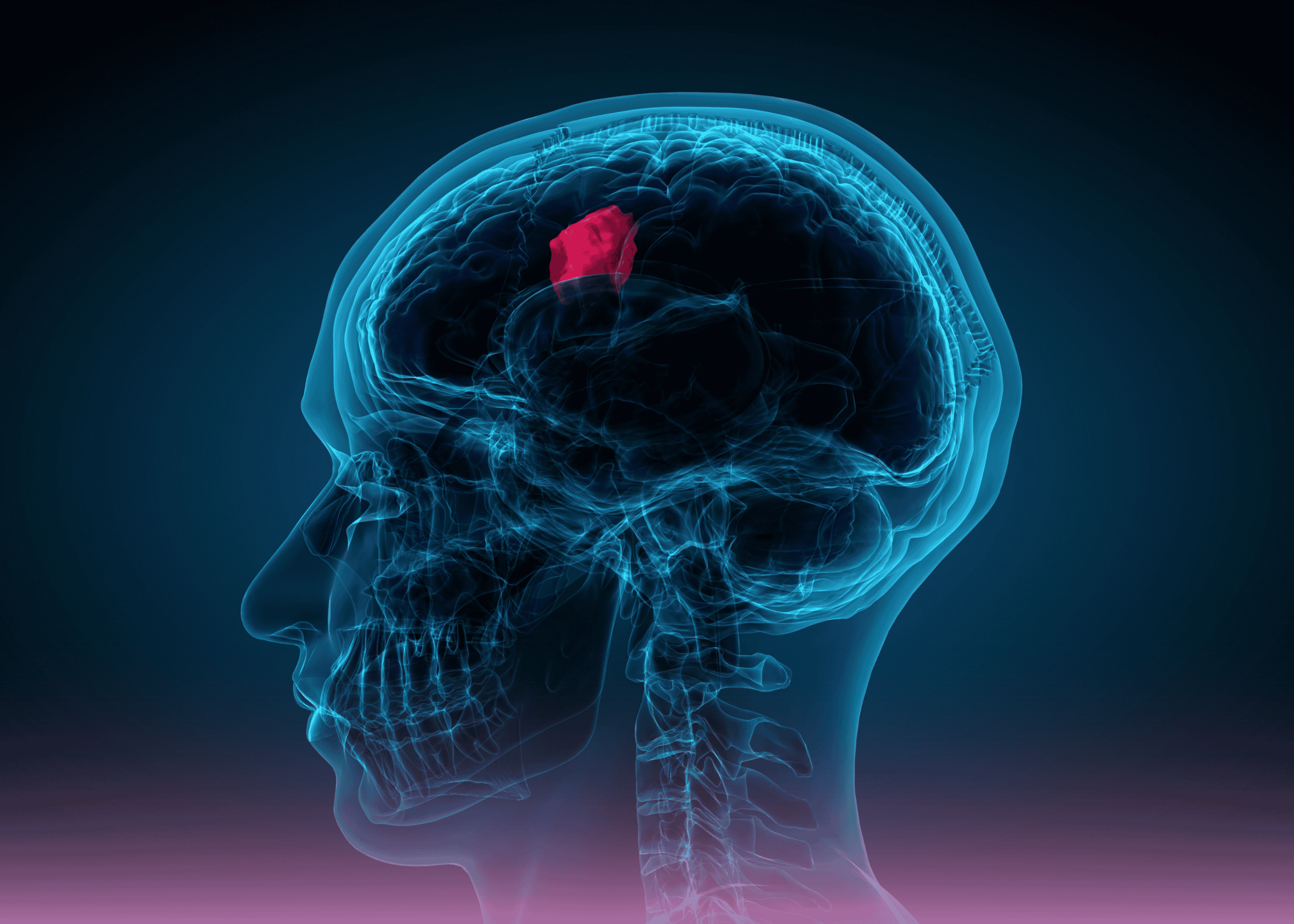 Advanced Neuro-Navigation Enables Successful Resection of Complex Brain Tumor