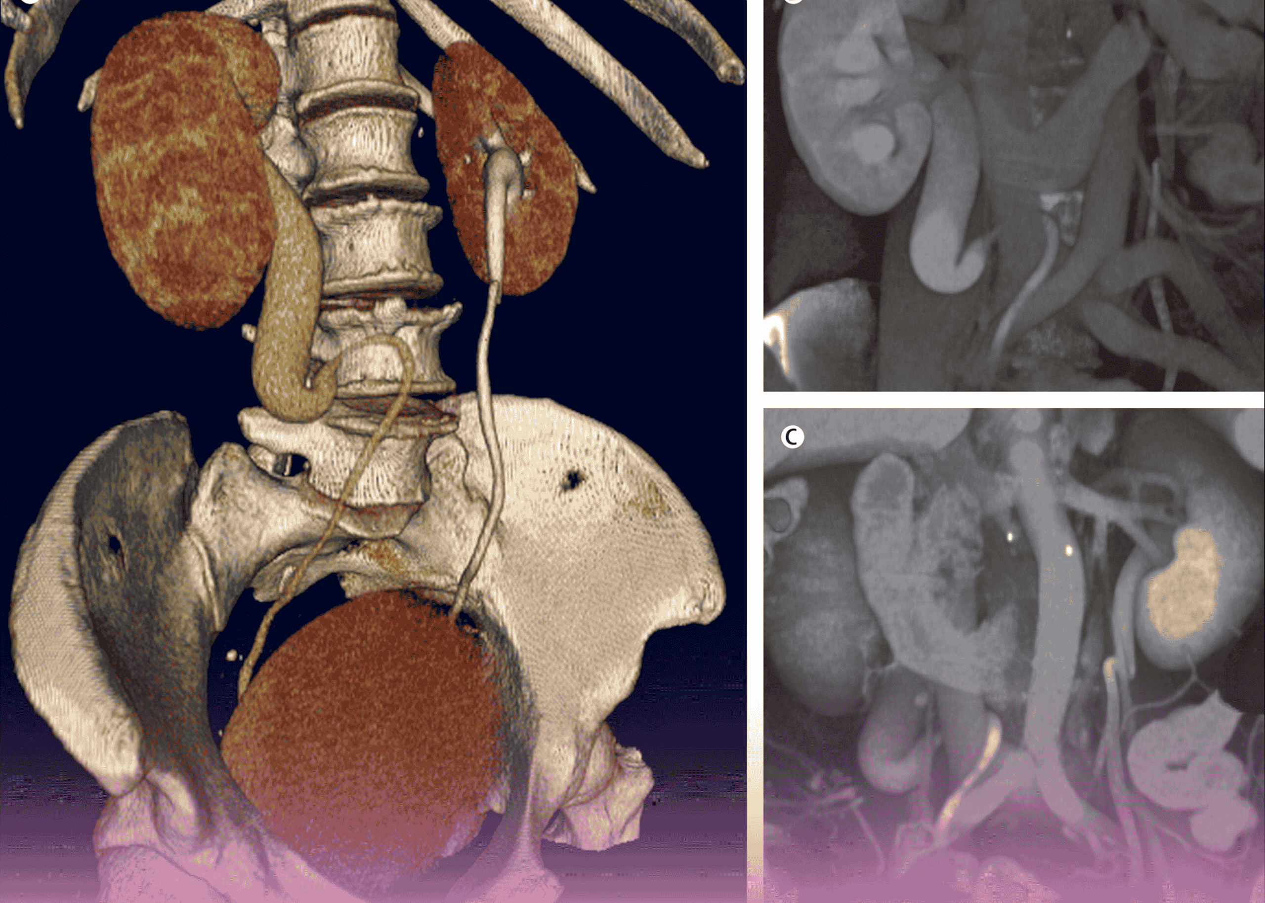 Retrocaval Ureter: Diagnosing and Managing a Globally Rare Congenital Condition