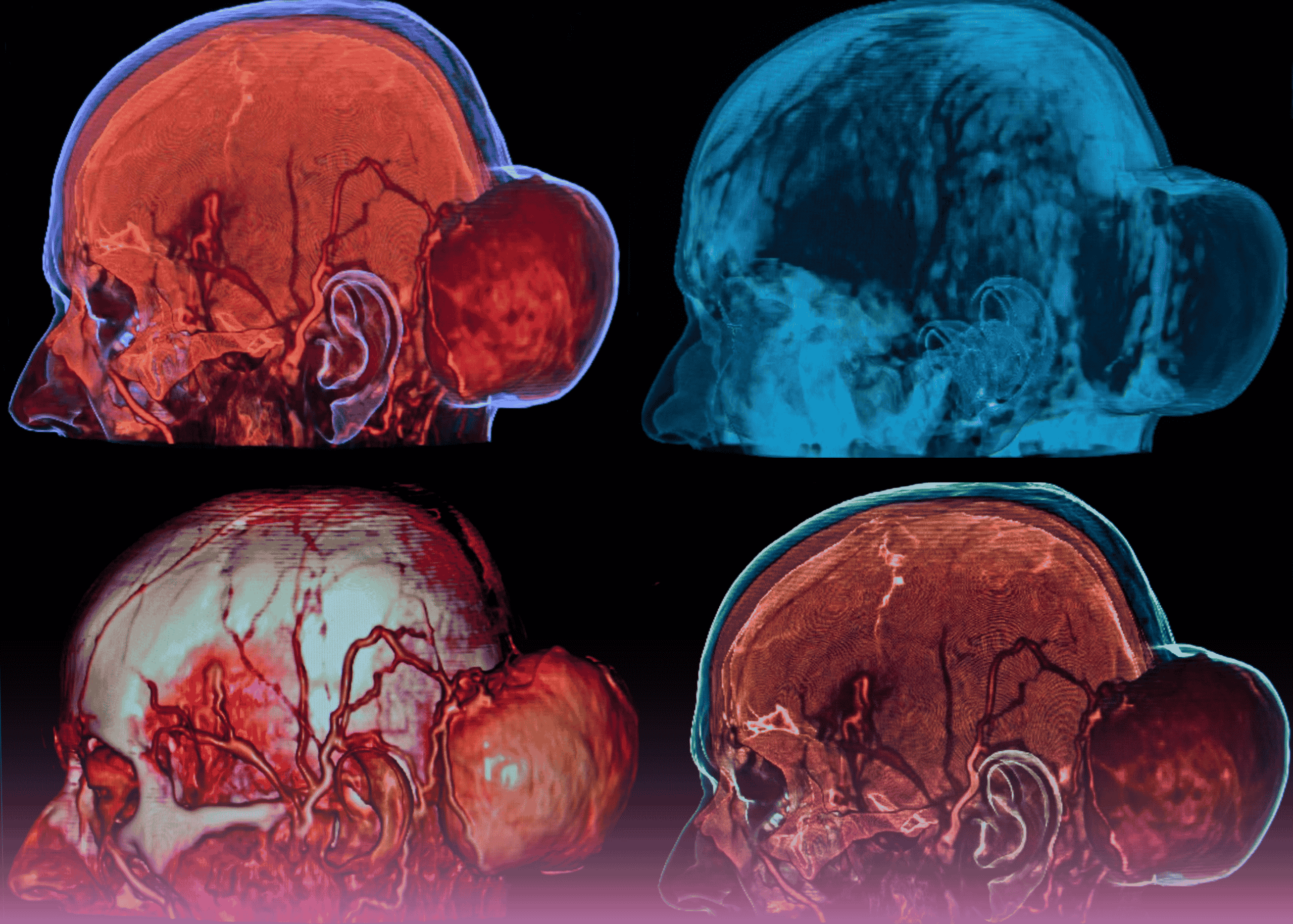 Clival Chordoma with Brain Stem Compression: Navigating a Complex Neurosurgical Challenge