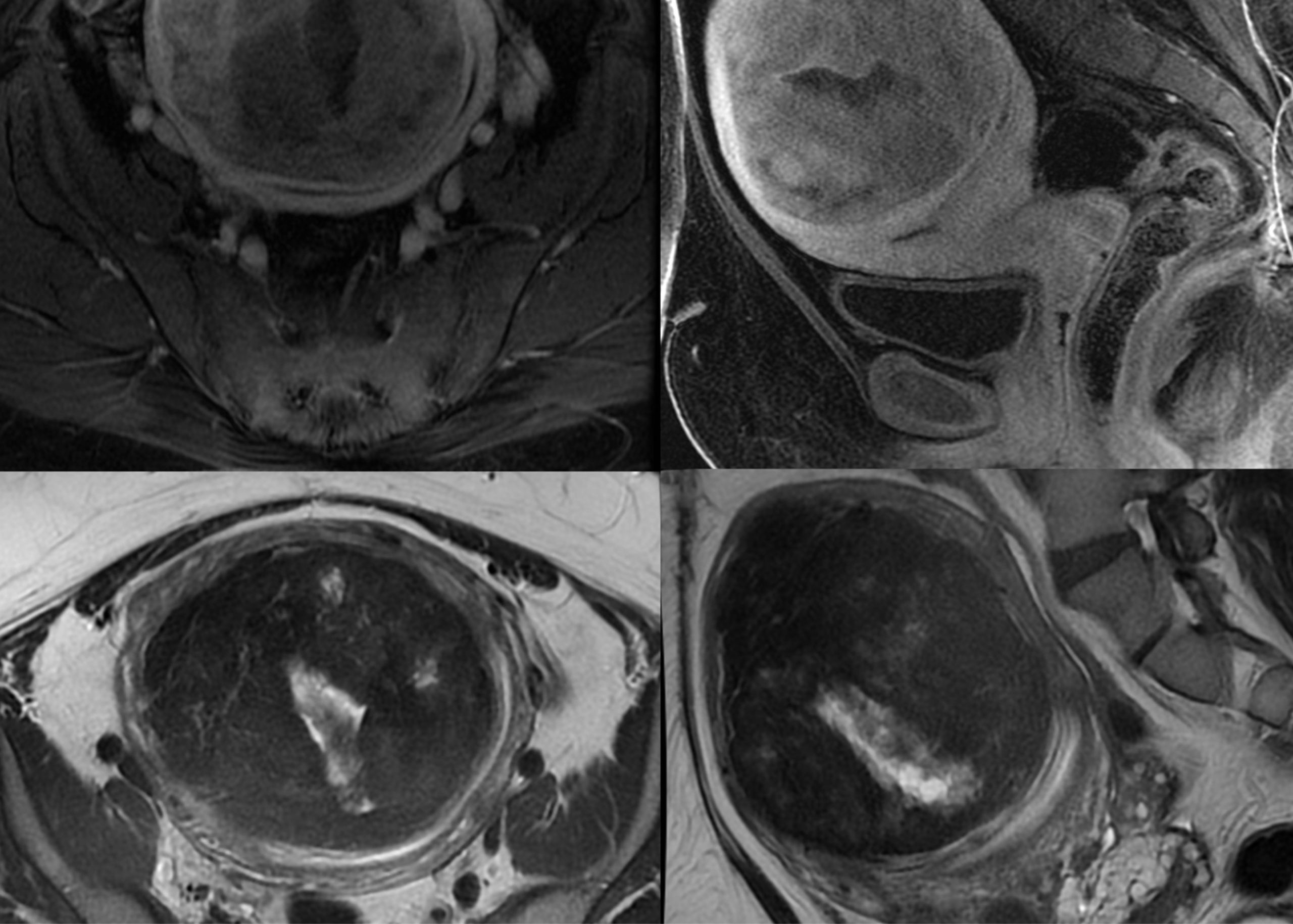 Uterine Fibroids