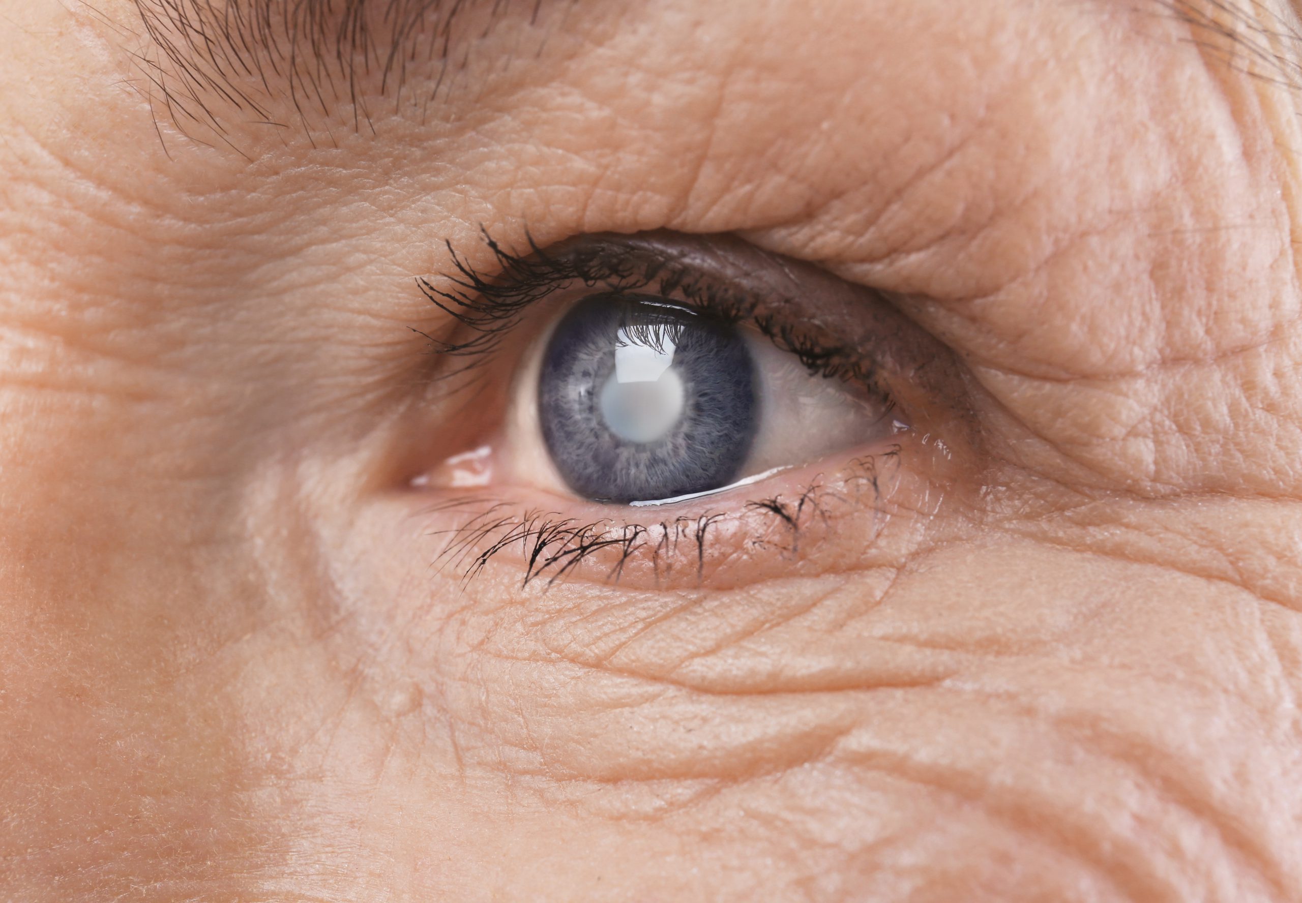 What is Glaucoma?