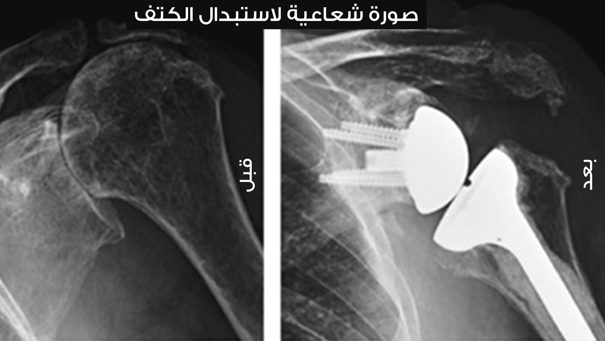 جراحة استبدال الكتف  