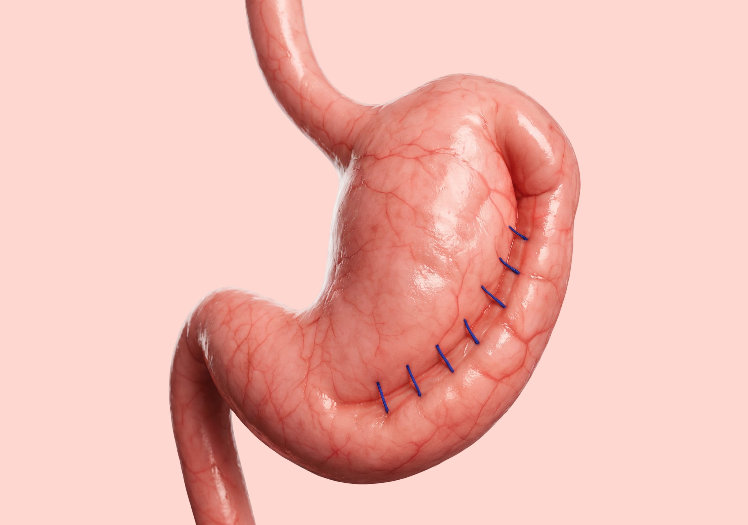What is Endoscopic Sleeve Gastroplasty and is it right for you