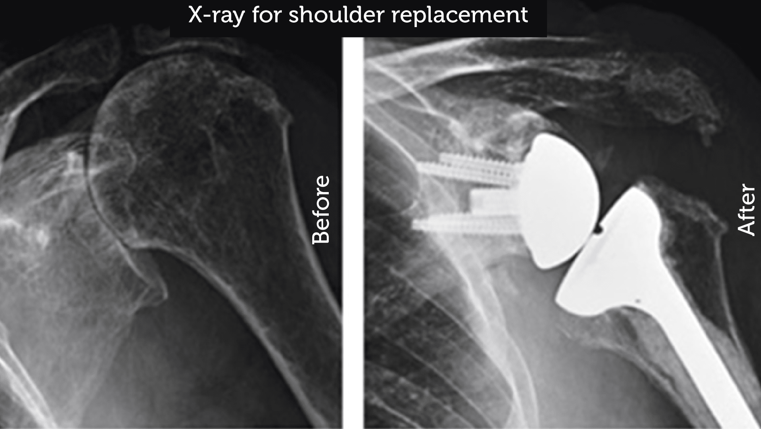 Shoulder Replacement  