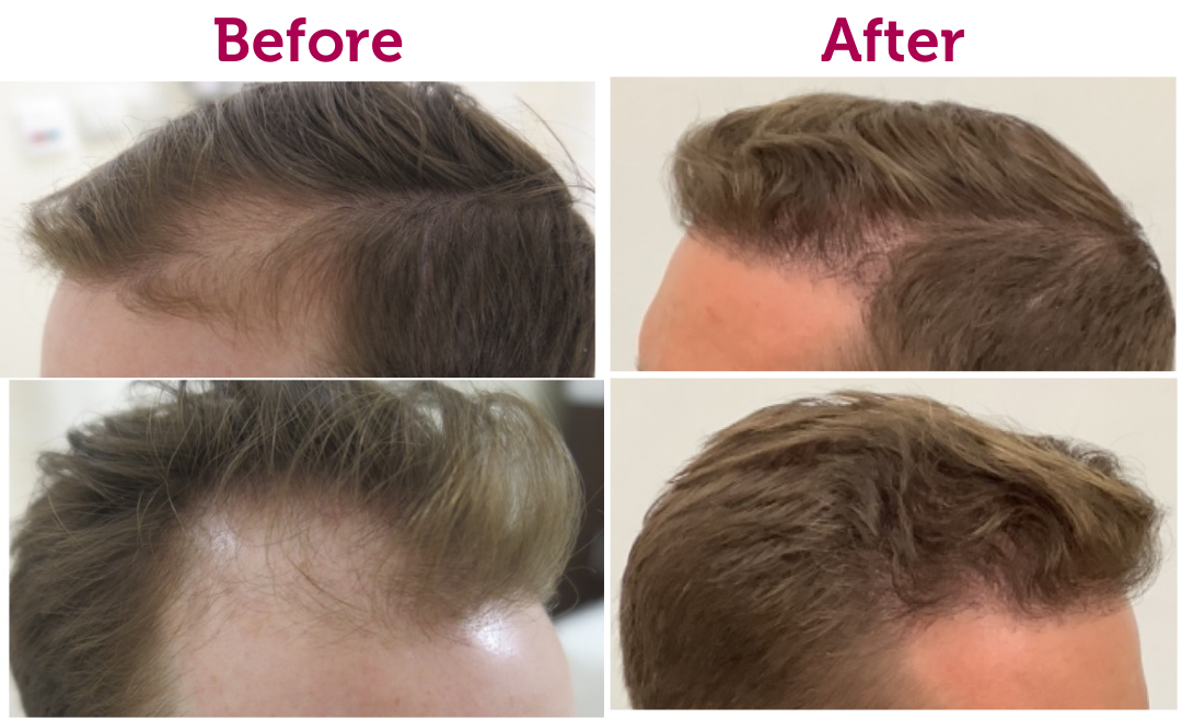 Hair Transplant in Abu Dhabi Burjeel Day Surgery Center, Al Reem Island