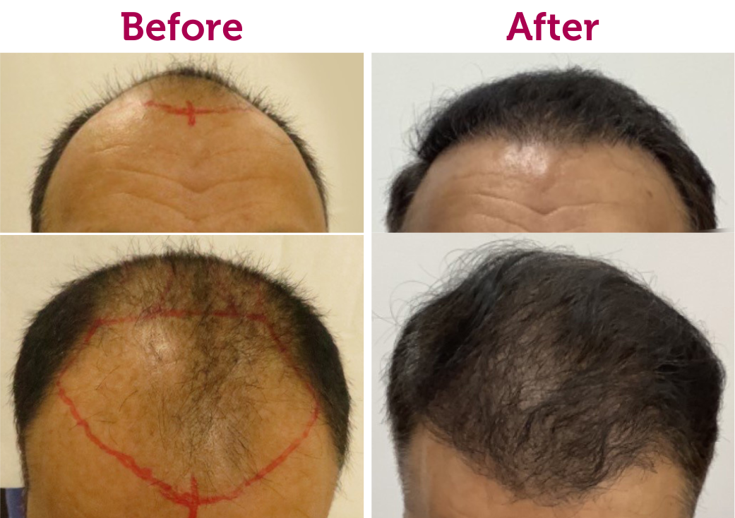 Hair Transplant in Abu Dhabi Burjeel Day Surgery Center, Al Reem Island