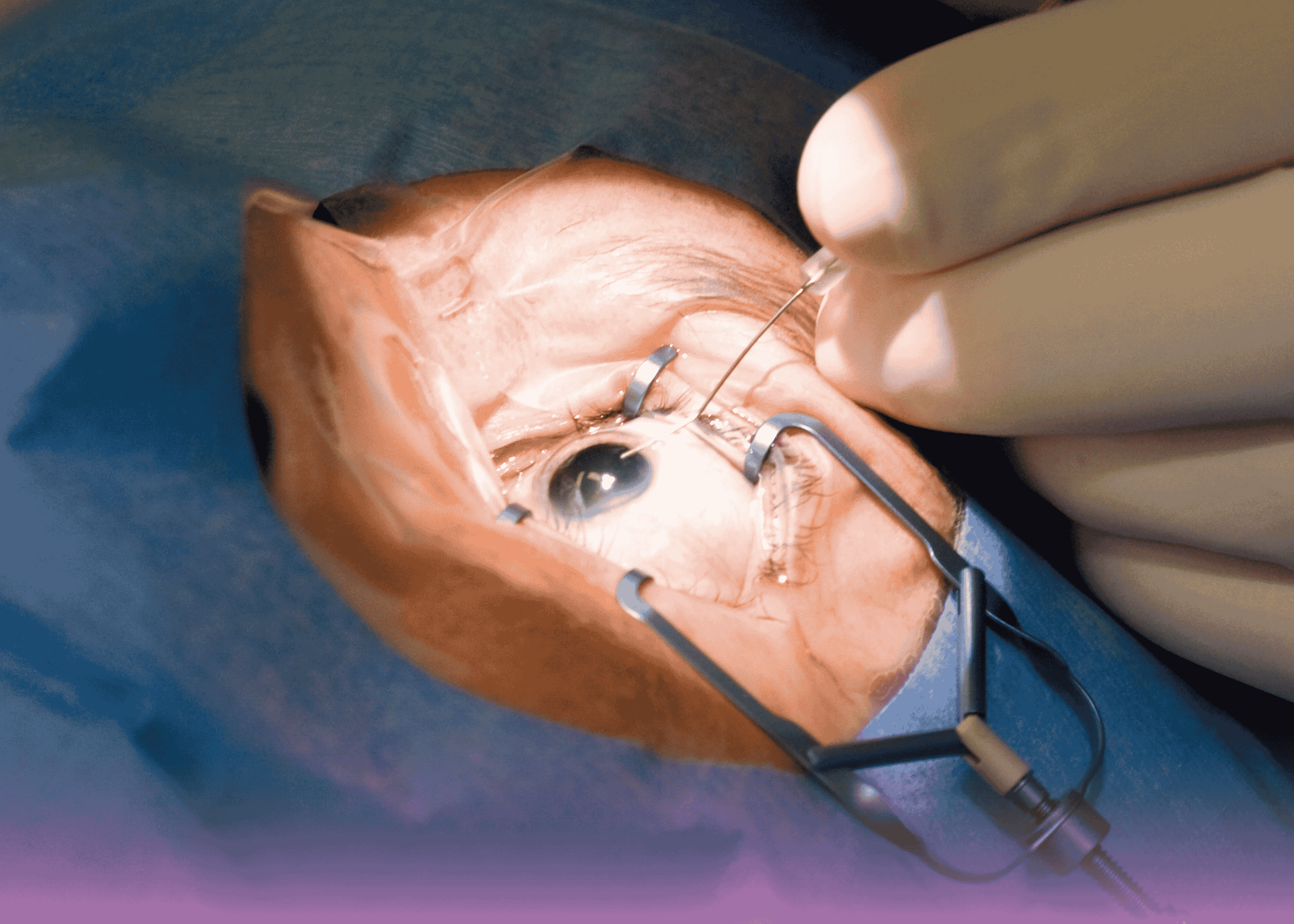 Emergency Eye Surgery: Removing Large Metallic Foreign Body from Orbital Cavity