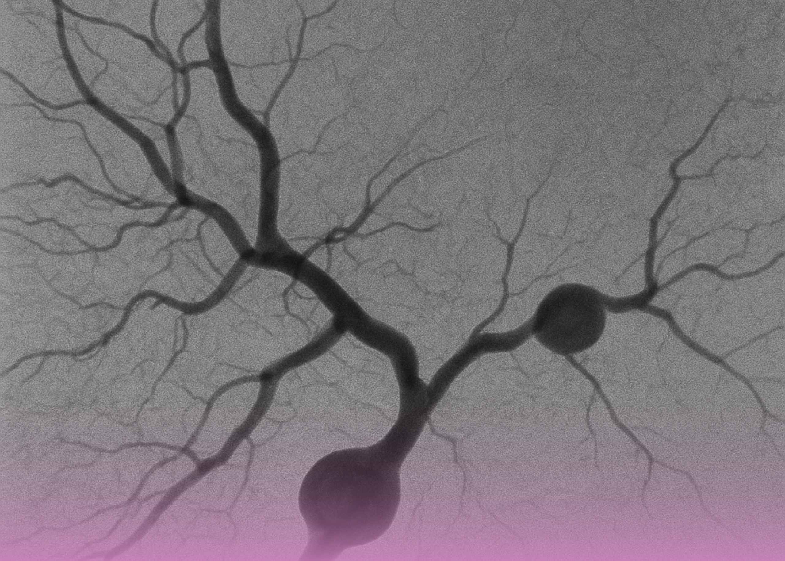 Rare Vascular Emergency Successfully Treated with Advanced Endovascular Surgery