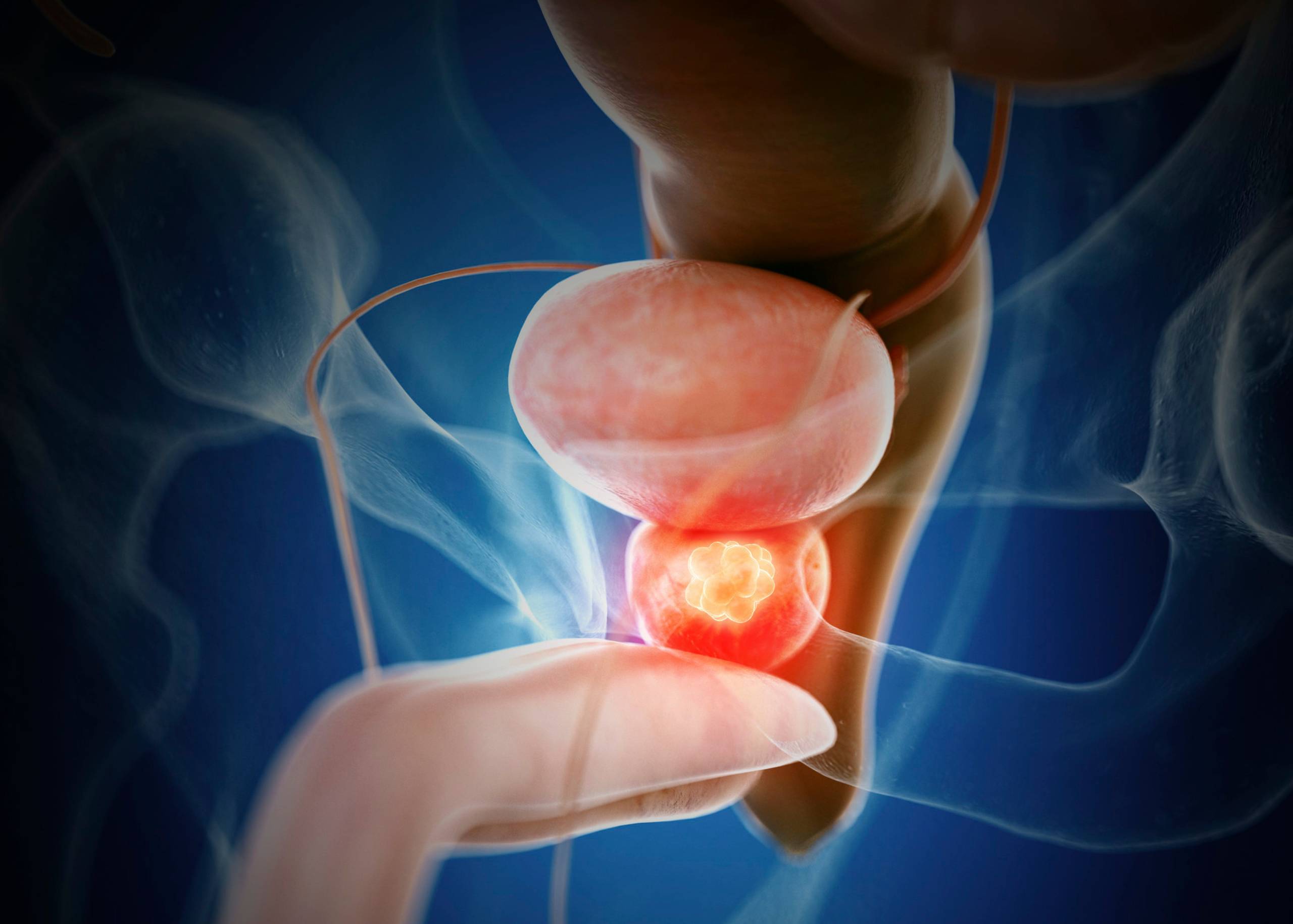 Prostate Cancer – Symptoms, Causes & Treatment
