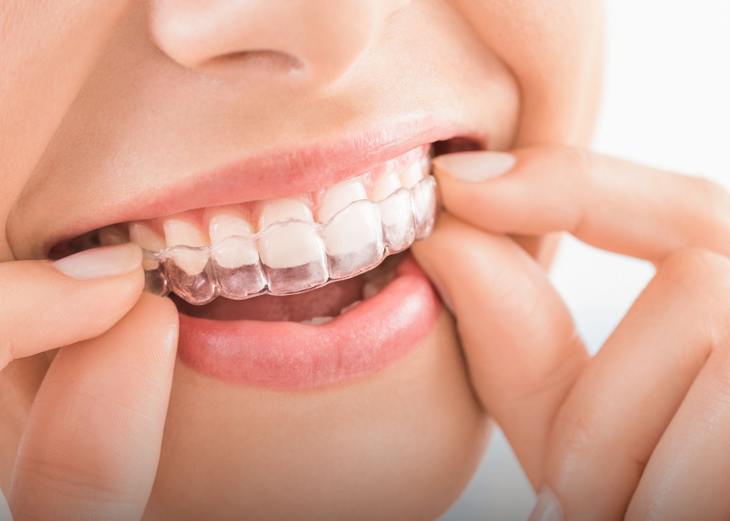 تقويم الأسنان إنفيزالاين: تحويل الابتسامات بواسطة المحاذايات الشفافة