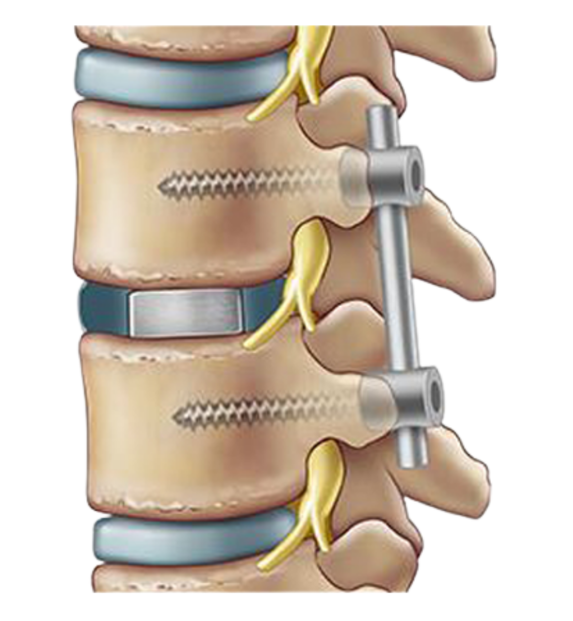 scoliosis-spinal-deformity-correction-in-uae