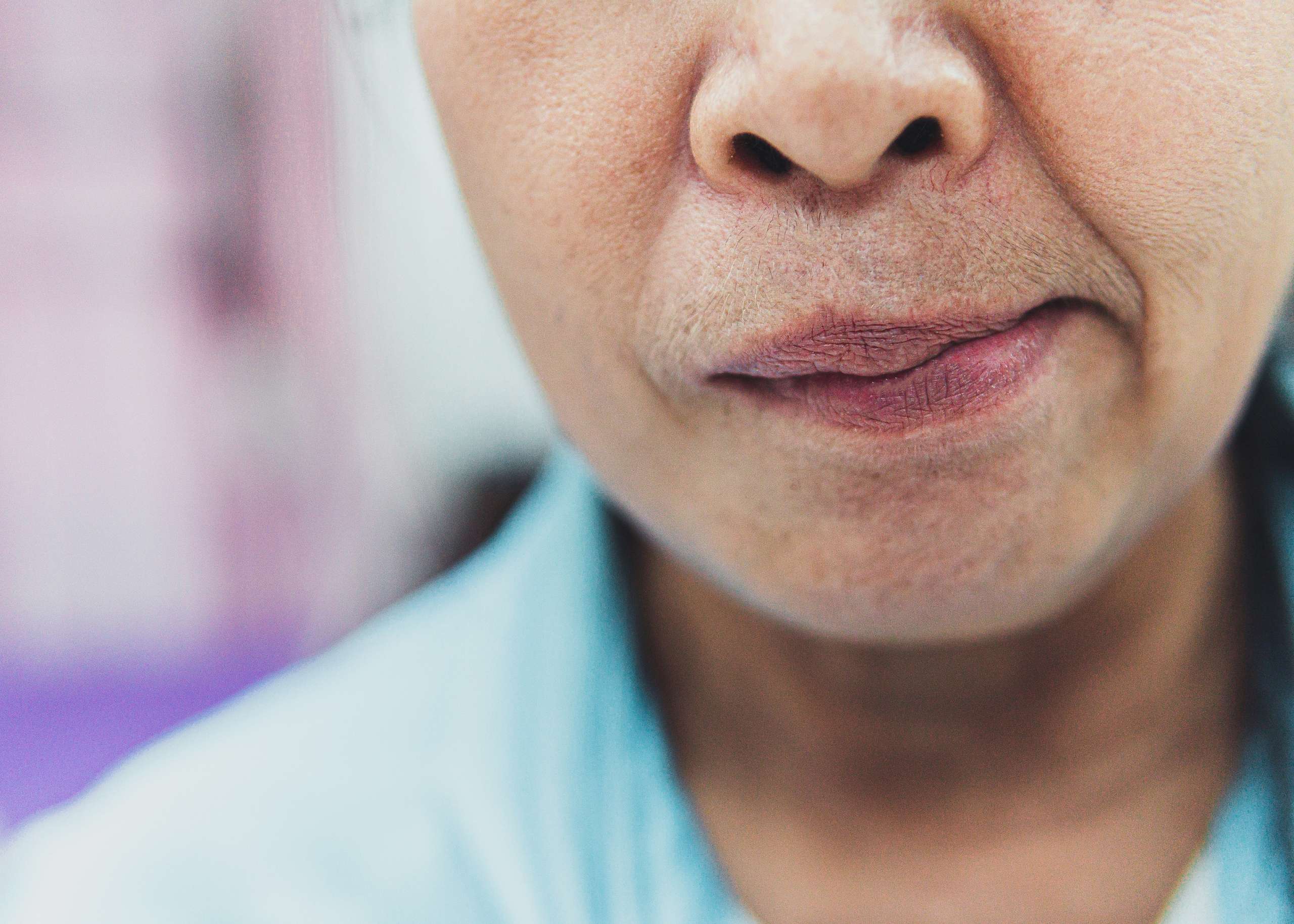 Bell’s Palsy – Symptoms, Causes & Treatment