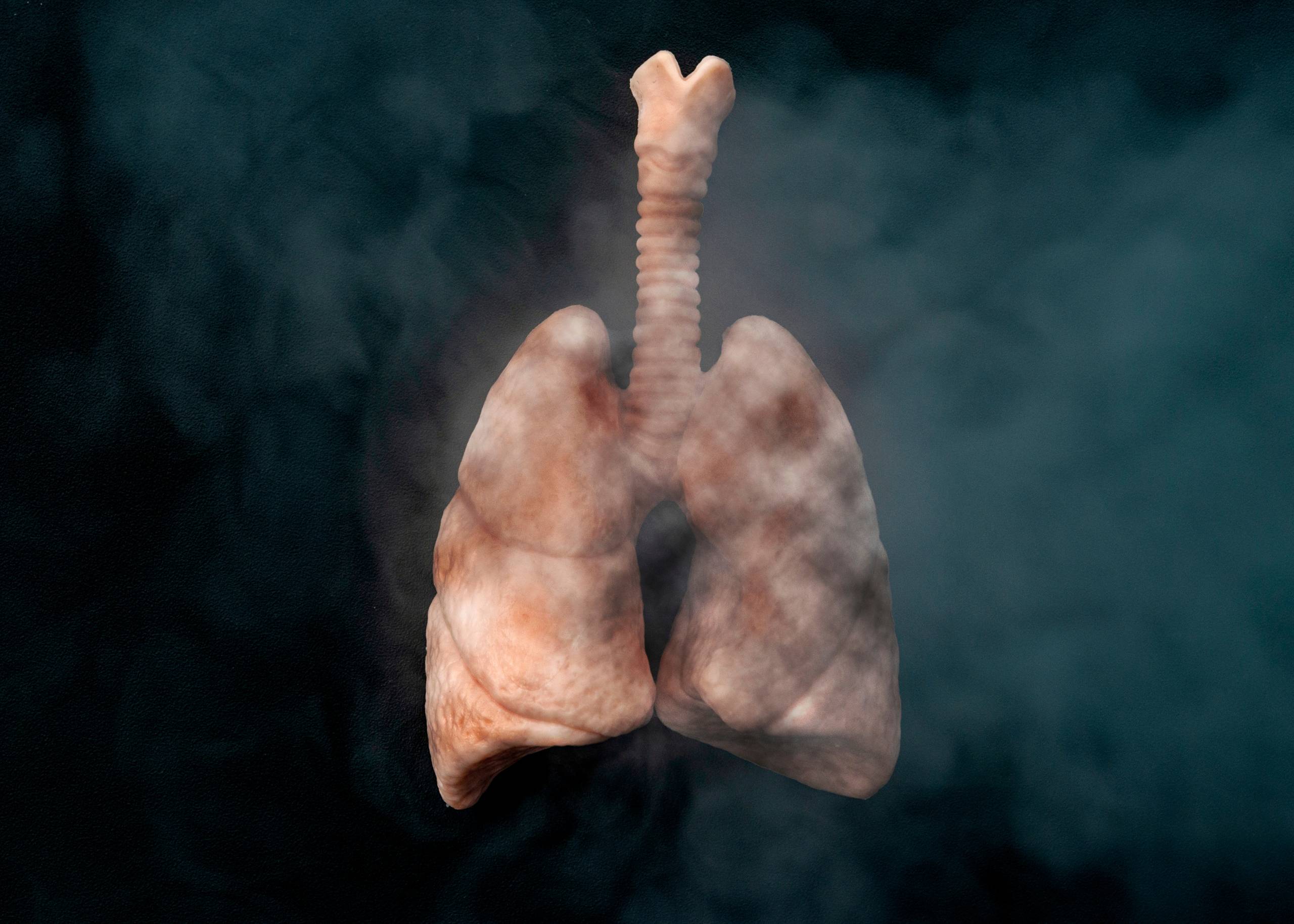 Lung Cancer – Symptoms, Causes & Treatment