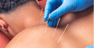 Dry Needling