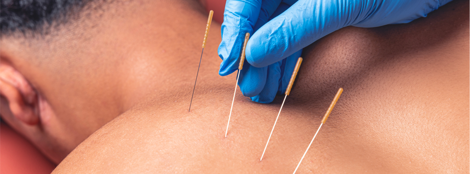 Dry Needling