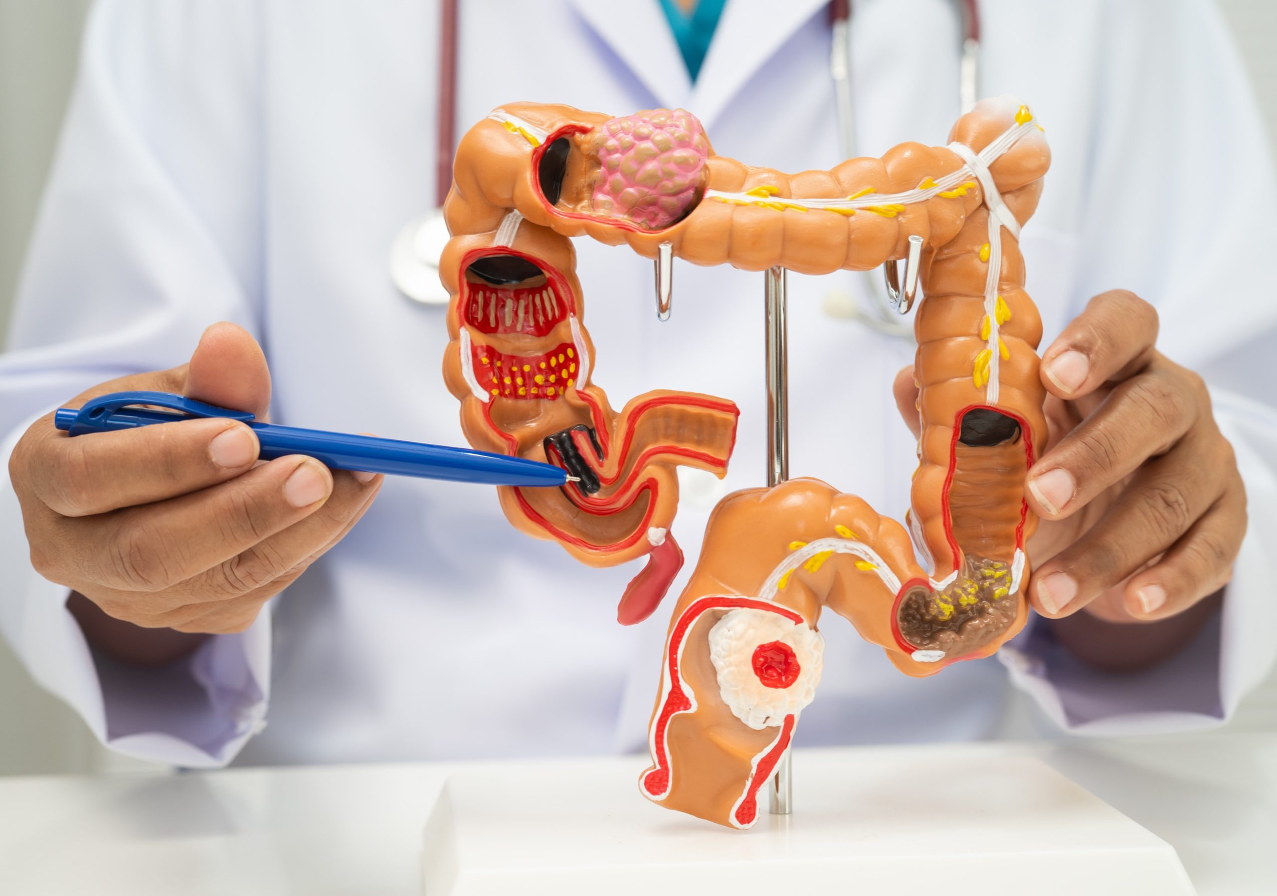 Who Should Get a Colonoscopy & When? A Complete Screening Guide for Colon Cancer