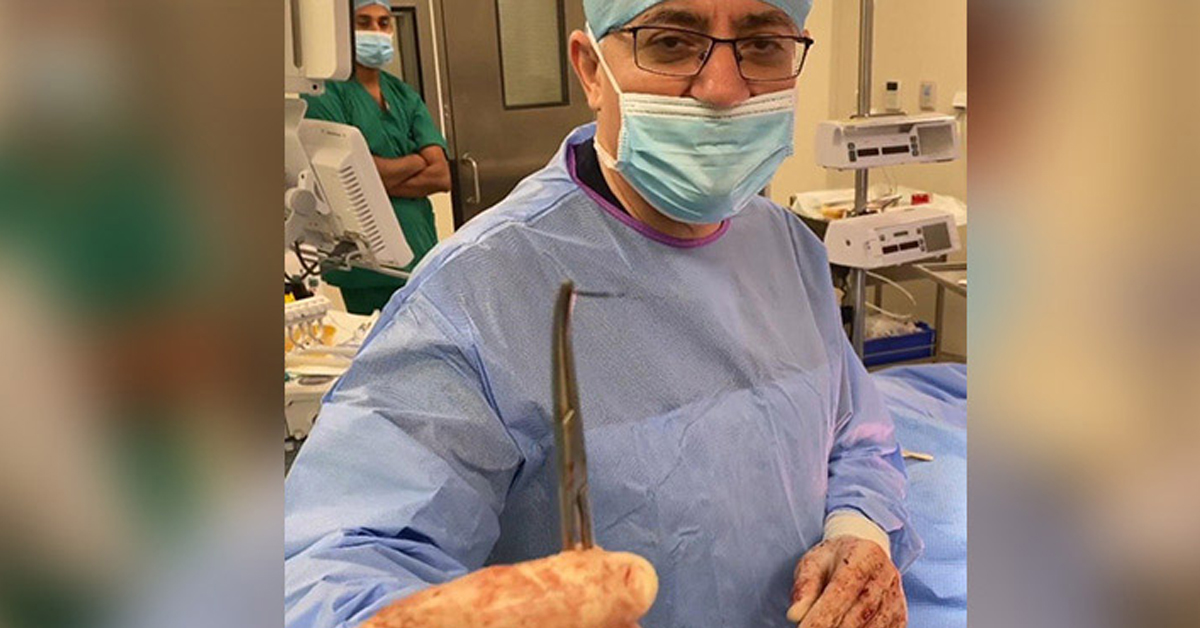 Broken needle left in body during surgery removed