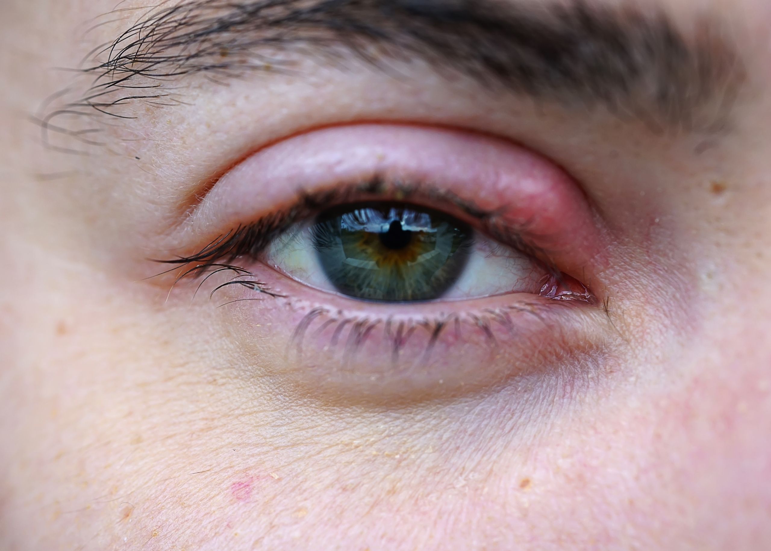 What is Retinopathy?