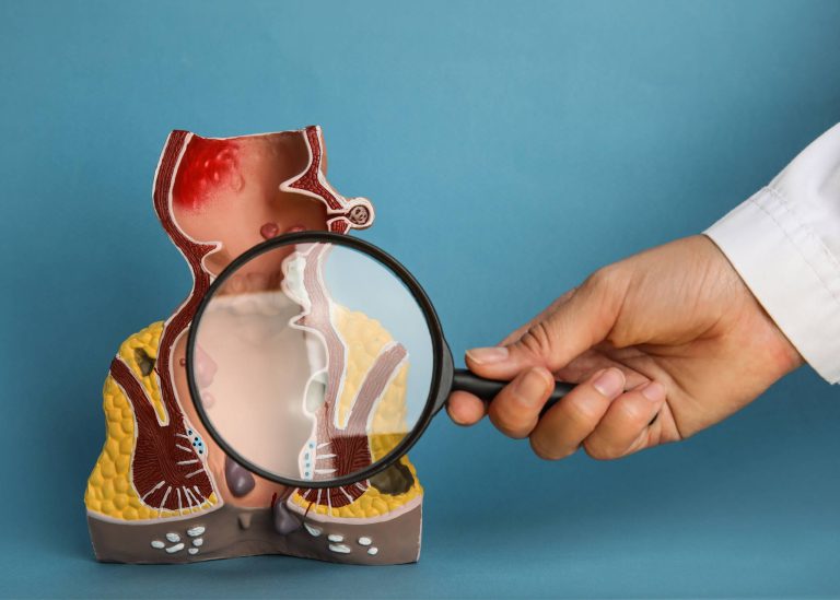 What are Anal Fissures?