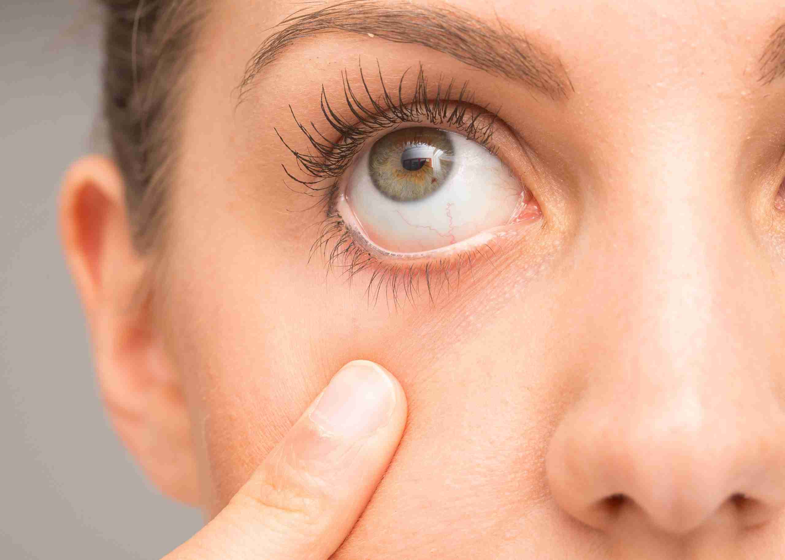 Dry Eyelids Causes