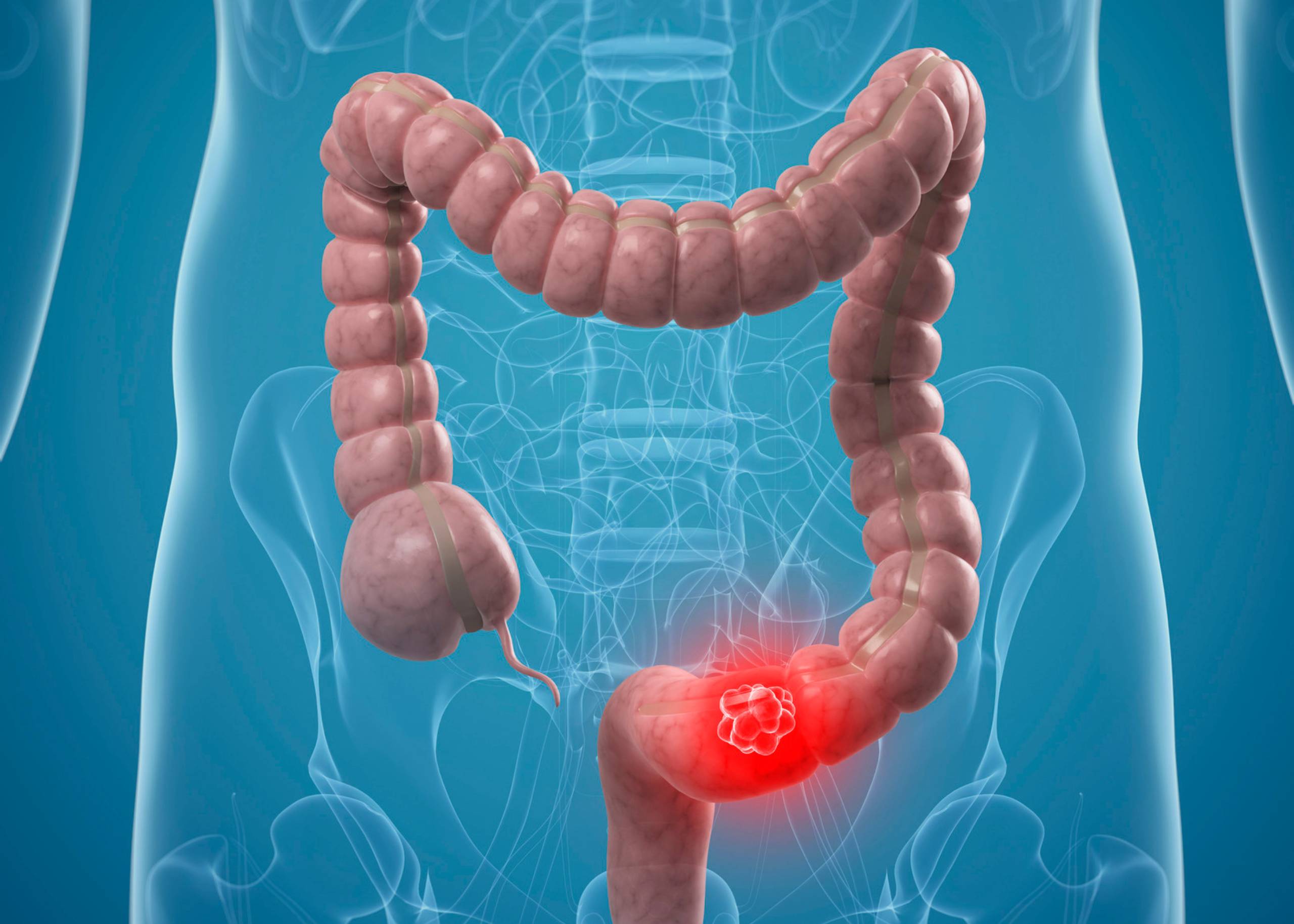 Colon Cancer – Symptoms, Causes ,and Treatment