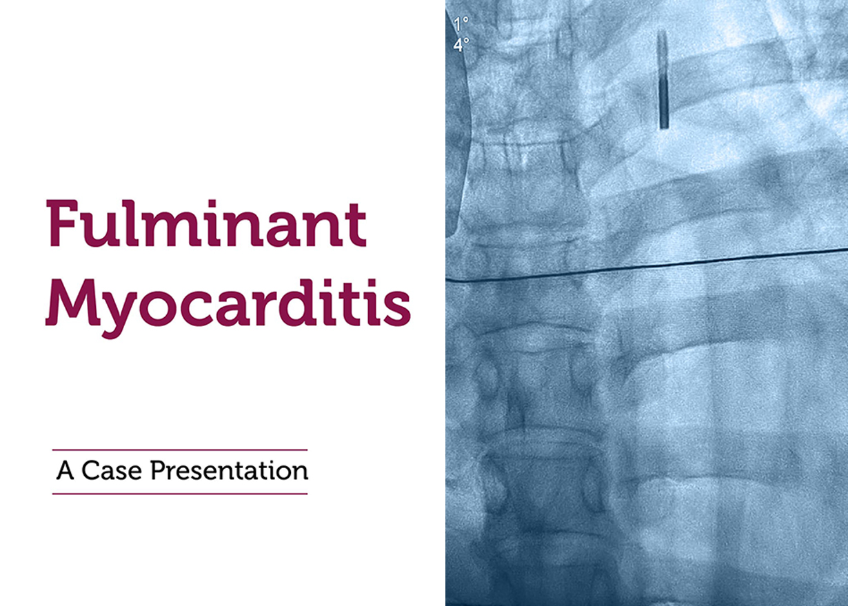From Crisis to Recovery: The Story of Fulminant Myocarditis Management 