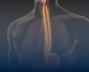 Esophageal Surgery