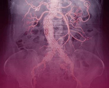 Aortic and Aneurysm Surgery