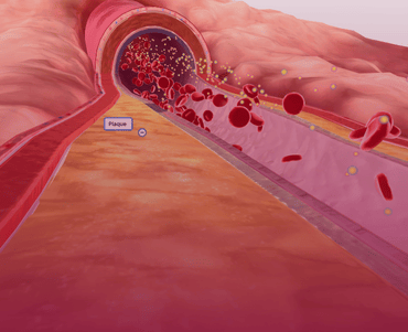 Carotid Artery Surgery