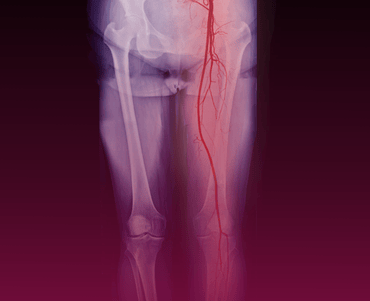 Peripheral Artery Disease (PAD) Management