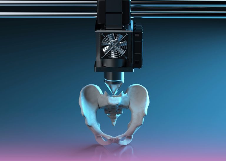 Custom 3D-Printed Implants Revolutionize Complex Hip Revision Surgery