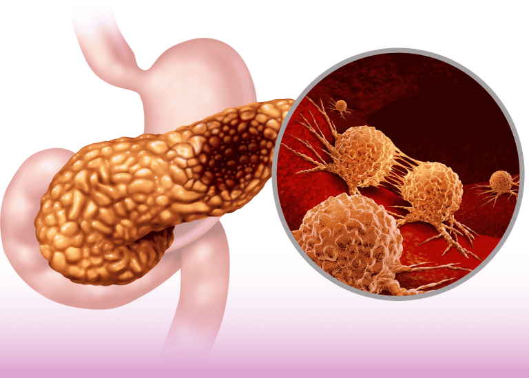 Advanced Laparoscopic Whipple Procedure: Faster Recovery for Pancreatic Cancer Patients