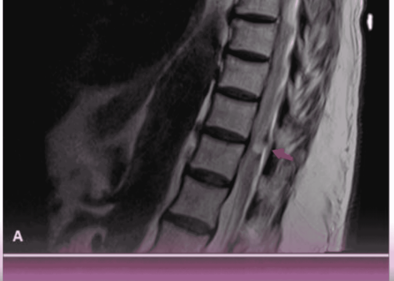 التهاب الجذور الكيميائي: نهج جديد لفهم وعلاج عرق النسا غير الانضغاطي