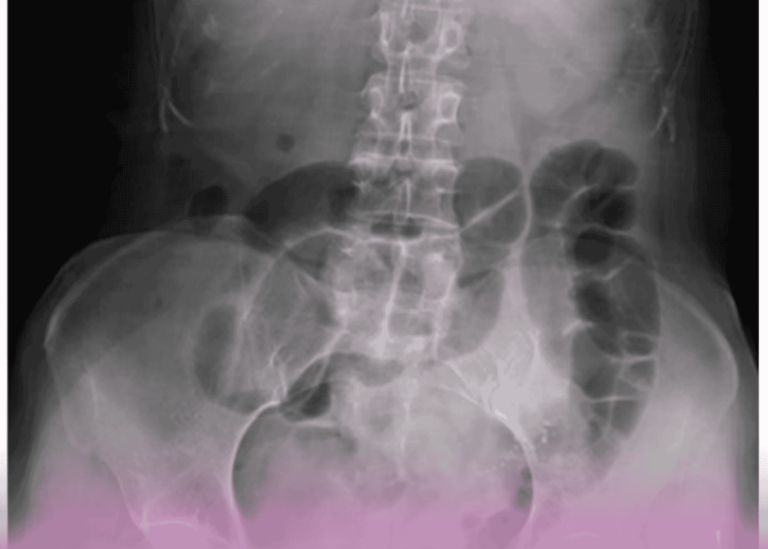 Adult Ileocolic Intussusception: A Rare Case Study & Surgical Management