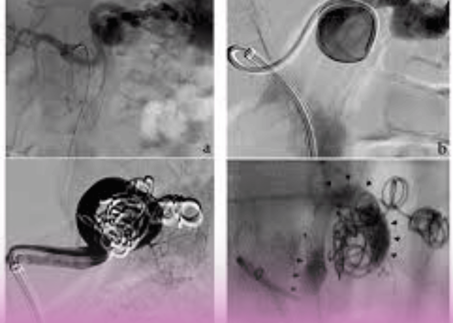 Innovative Coil-and-Glue Technique for Hepatic Artery Aneurysm