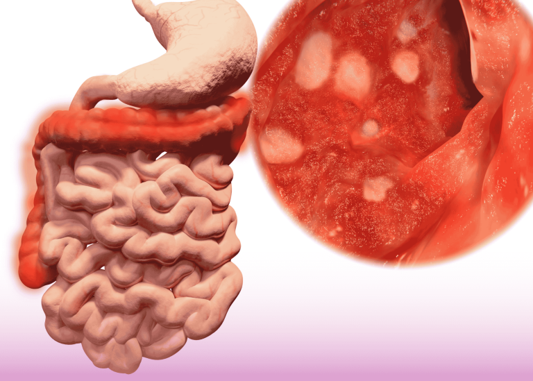 التهاب القولون الإقفاري مع ثقوب متعددة: حالة جراحية طارئة ونهج العلاج