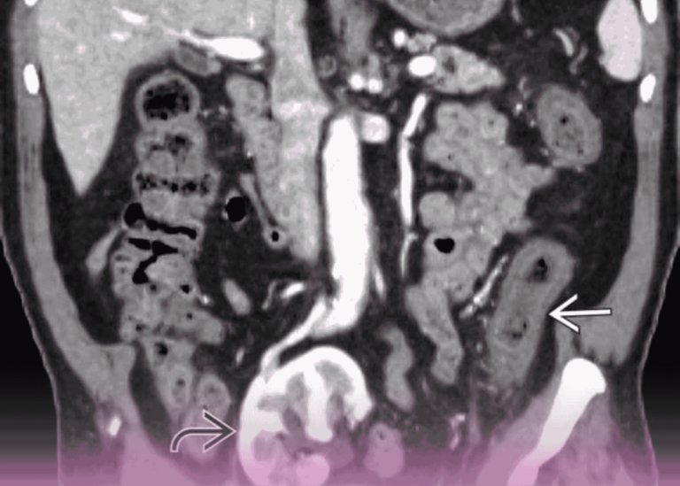 التهاب القولون الإقفاري مع ثقوب متعددة: التدبير الجراحي لحالة مهددة للحياة