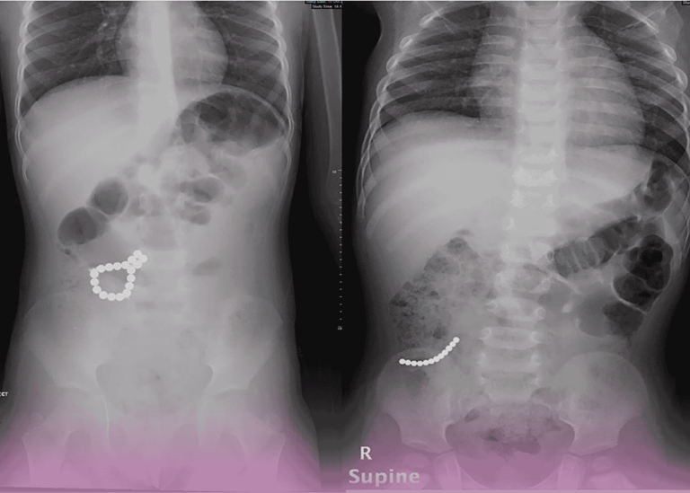 Life-Saving Intervention: Multidisciplinary Approach Saves Toddler Who Swallowed 17 Magnets
