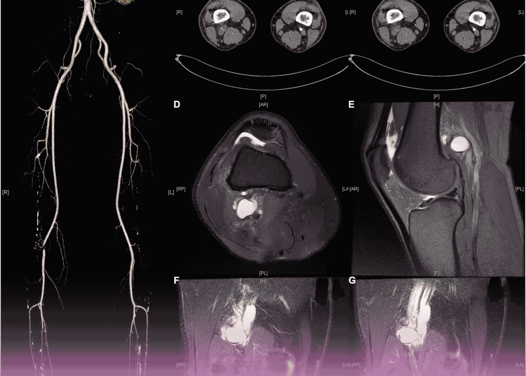 Vascular Rarea Successful Treatment of Cystic Adventitial Disease at Burjeel
