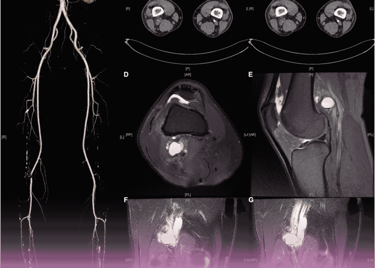 Rare Vascular Condition Successfully Treated: Cystic Adventitial Disease of the Popliteal Artery