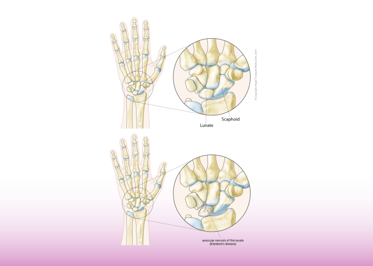 طُعم عظمي مُوعّى لمرض كينبوك المتقدم: ابتكار جراحي