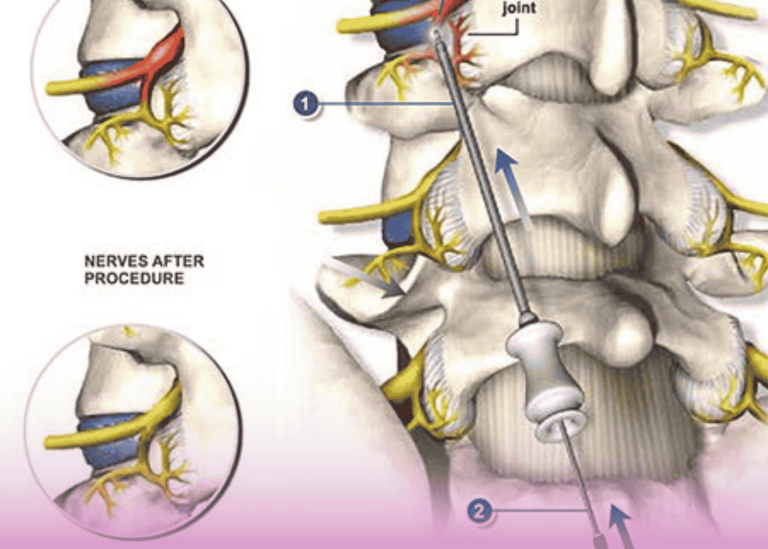 Lumbar Sympathetic Block: A Minimally Invasive Approach to Managing Complex Regional Pain Syndrome
