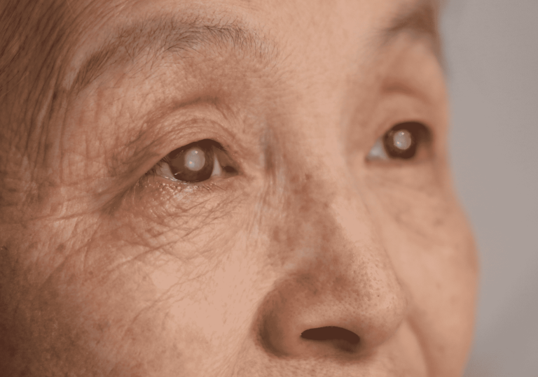 How Cataracts Cause Veil Blocking Vision and What You Can Do About It